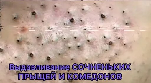 новое видео выдавливания прыщей