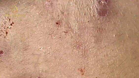 давить прыщи видео новинки смотреть бесплатно без регистрации в хорошем качестве 2023